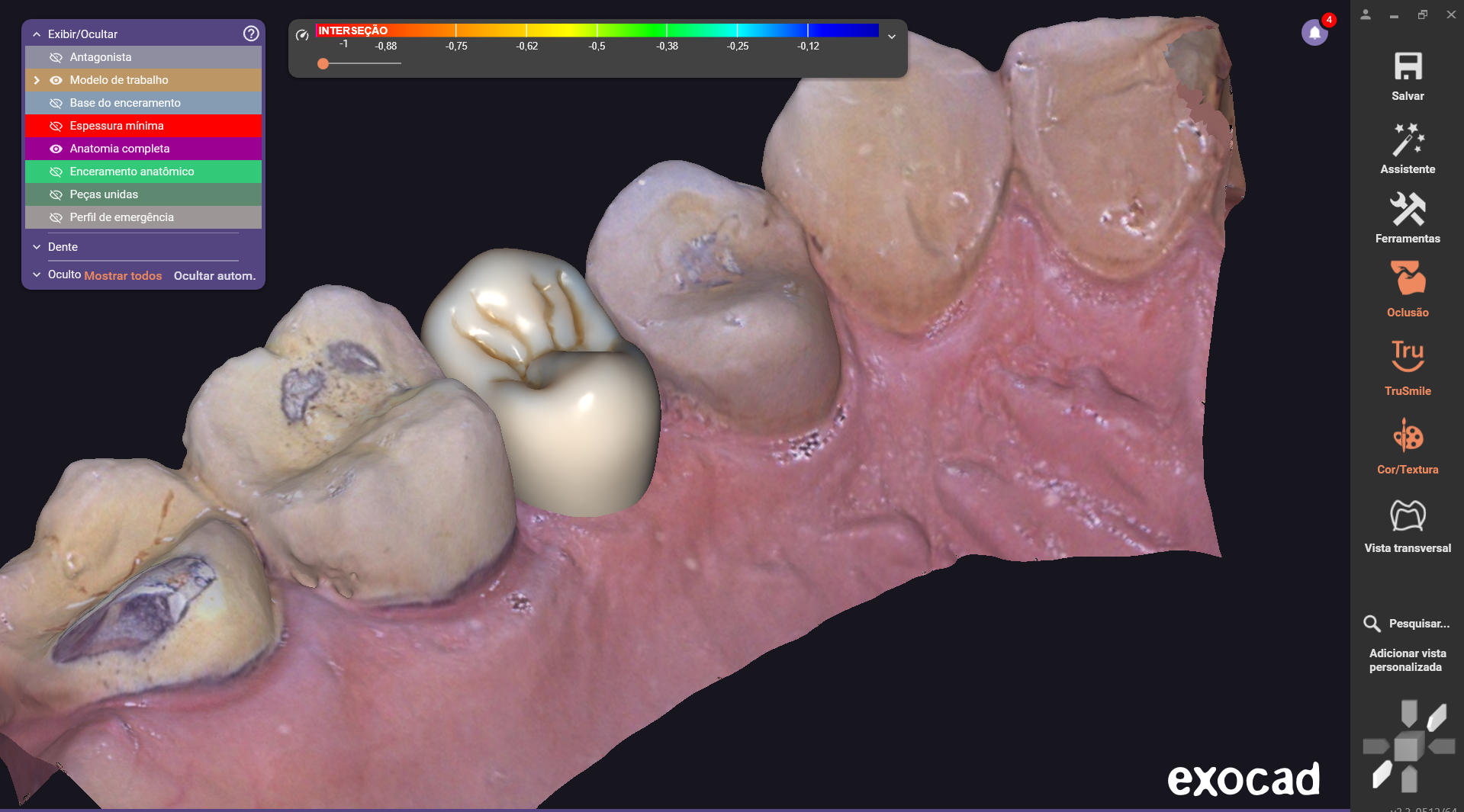 Anatomic Crown — Zirconia monolithic, tooth 15