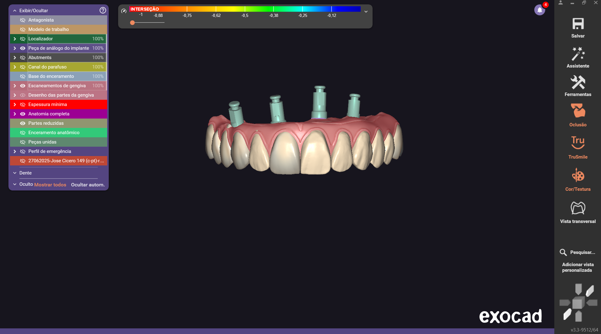 Full Arch — Screw-retained hybrid, 4 implants